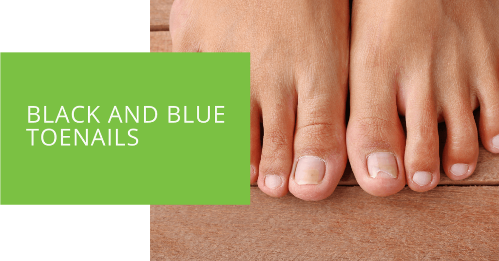 Black and Blue Toenails