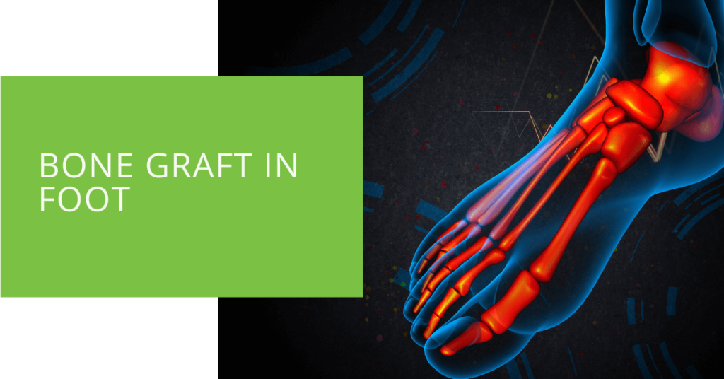 Bone Graft in Foot