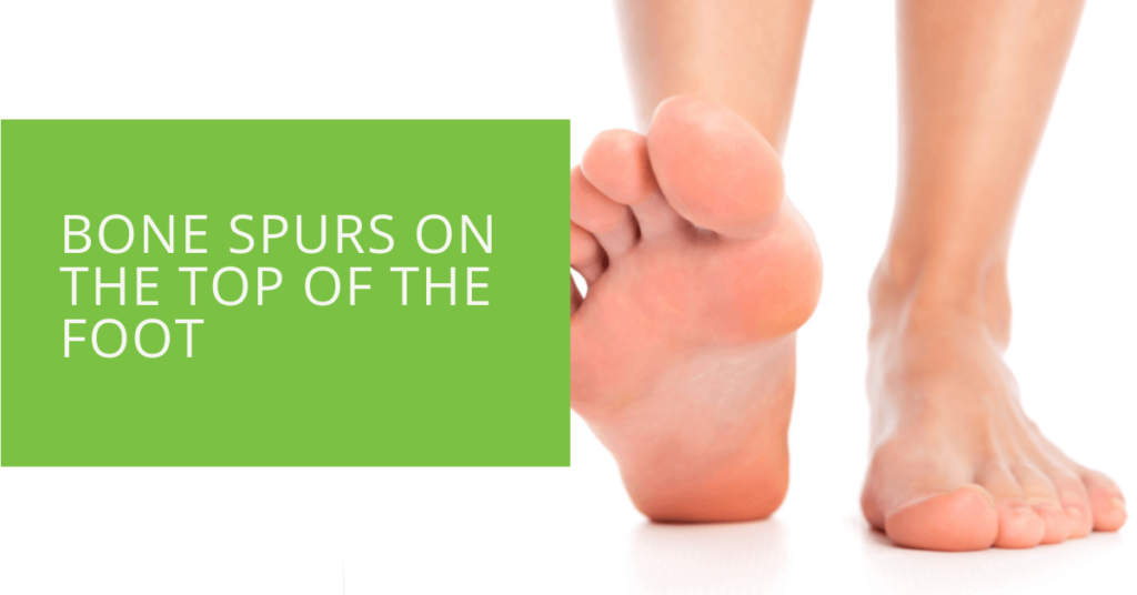 Bone Spurs on the Top of the Foot