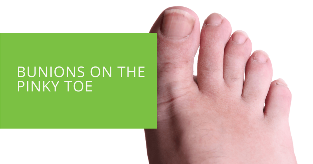 Bunions on the Pinky Toe