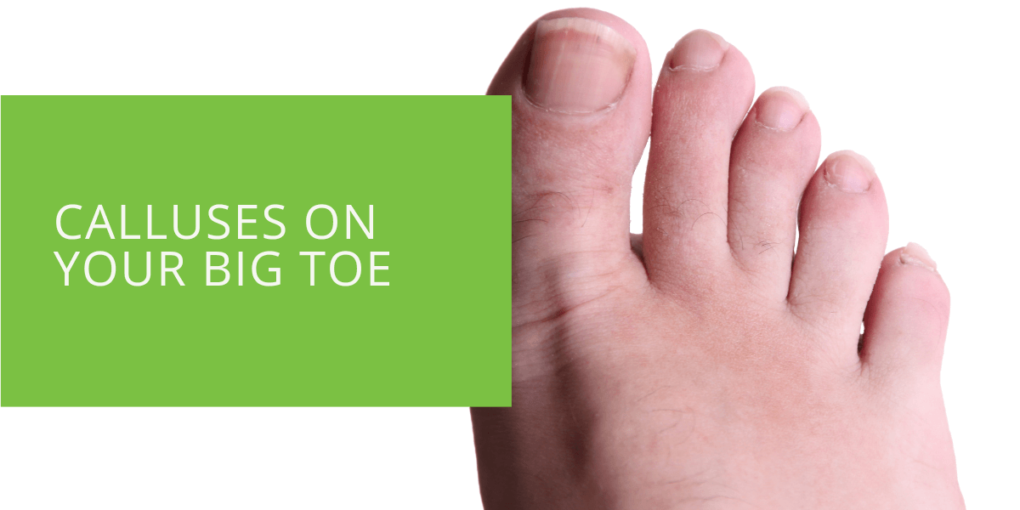 Calluses on Your Big Toe