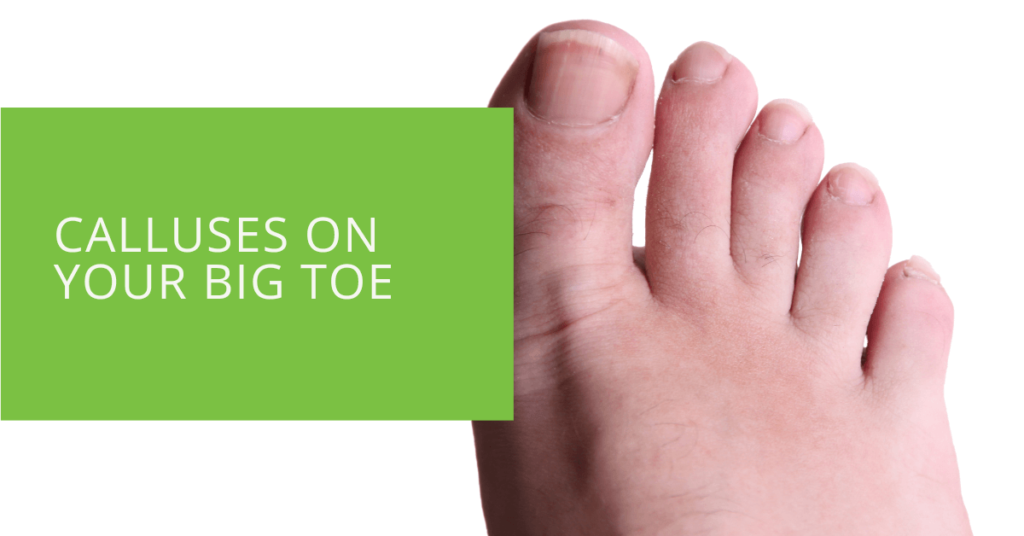 Calluses on Your Big Toe