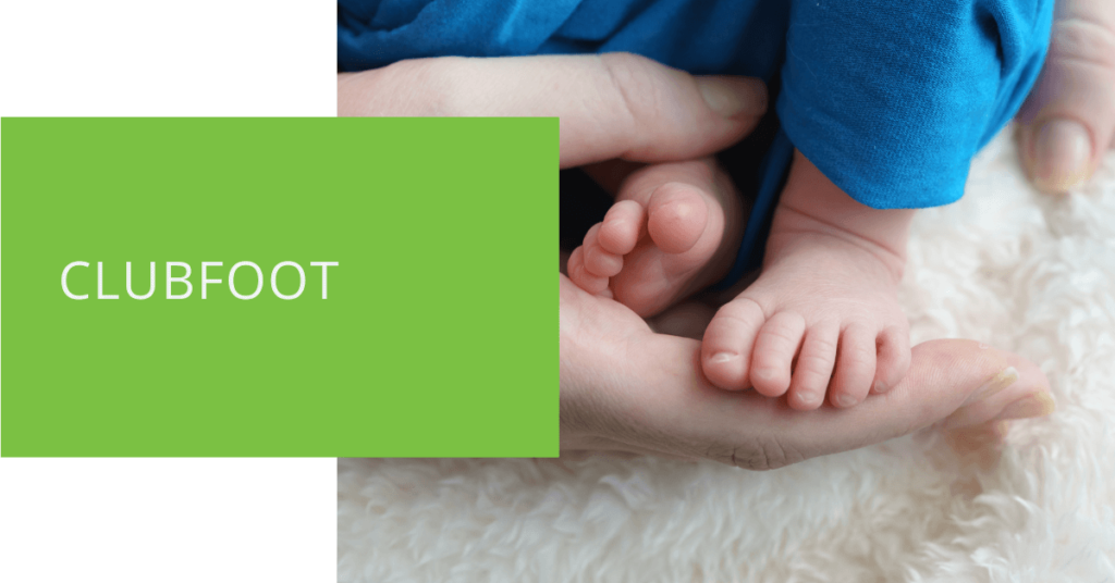Clubfoot