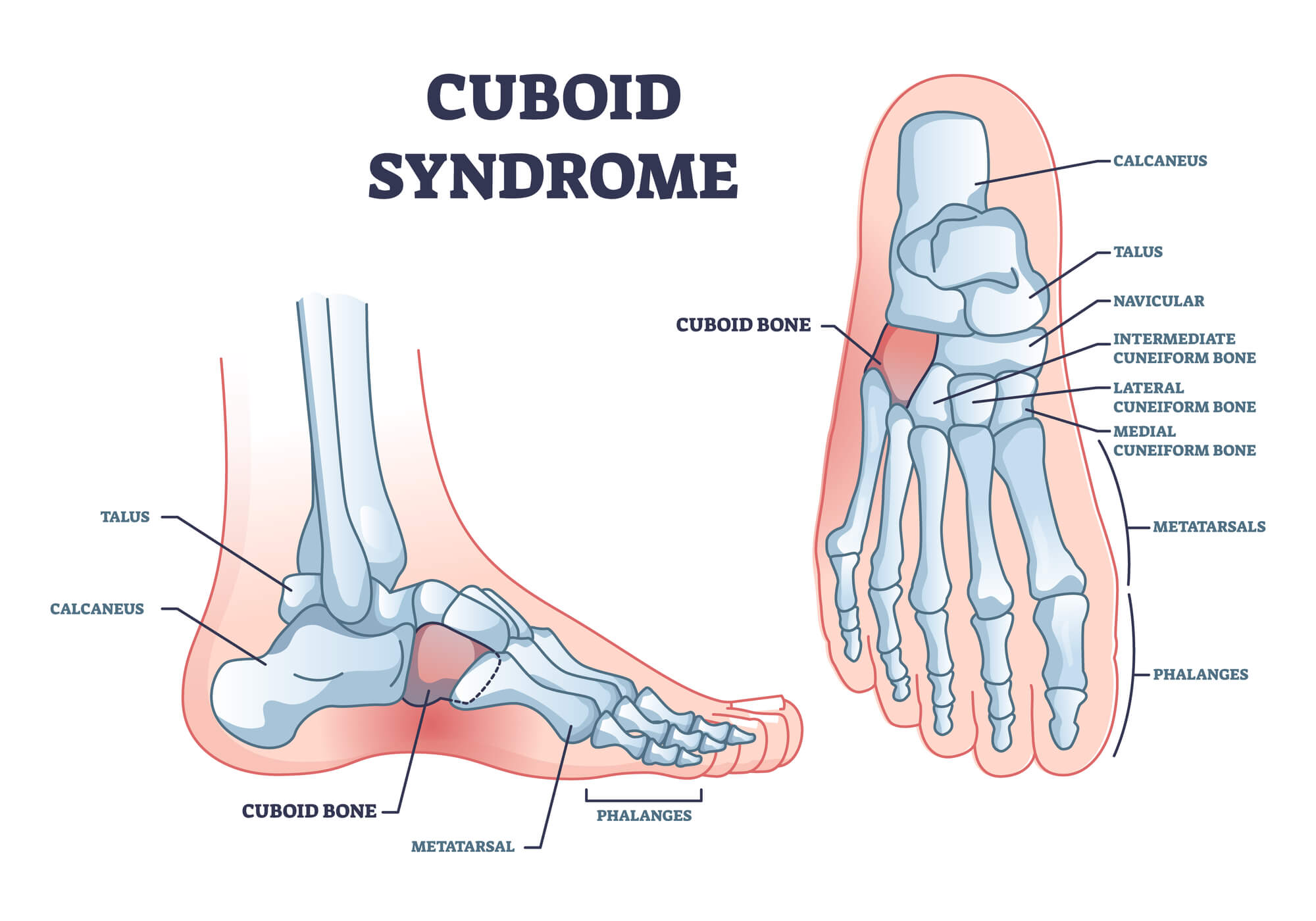 Cuboid Syndrome