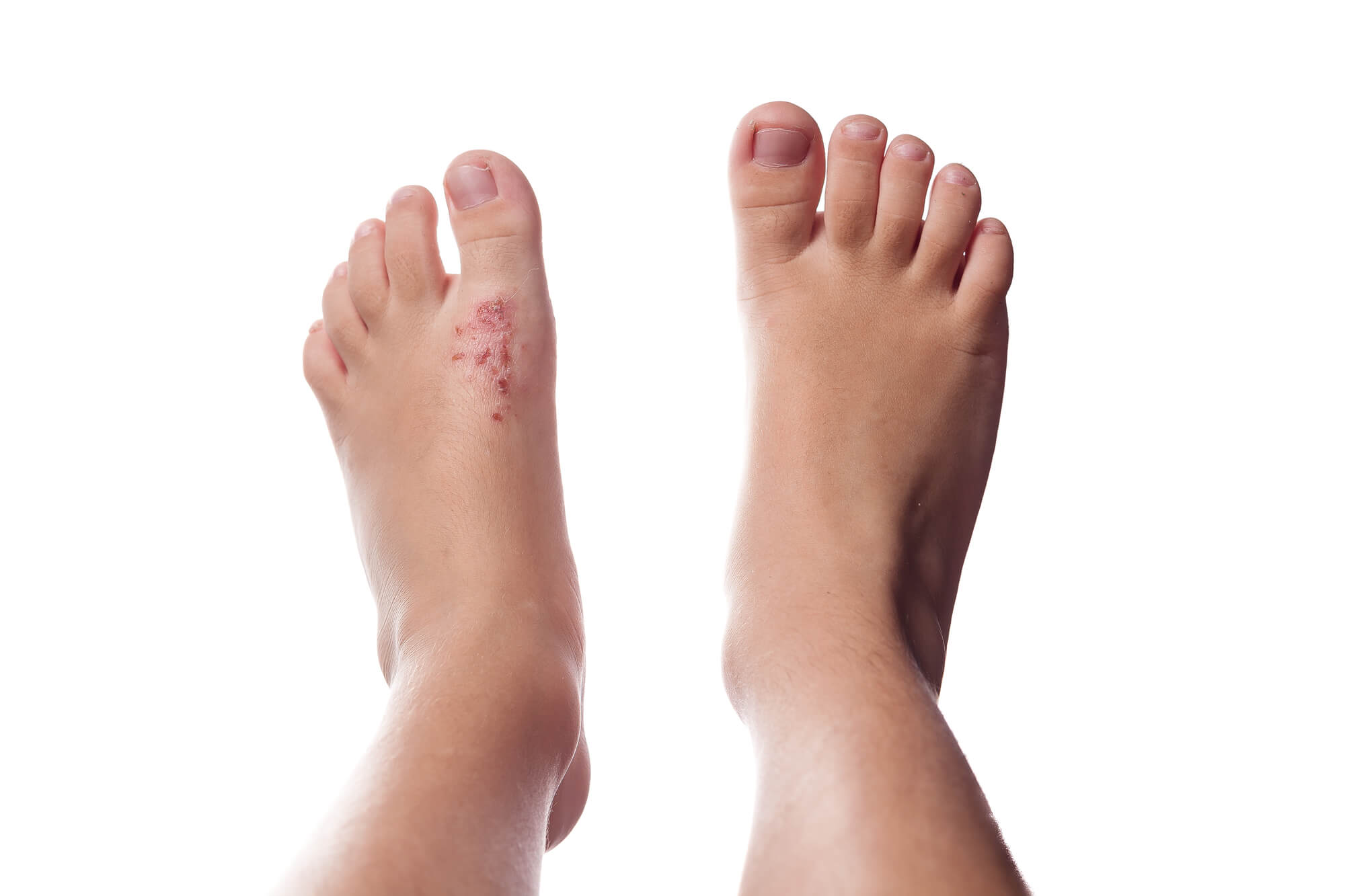 Eczema on foot