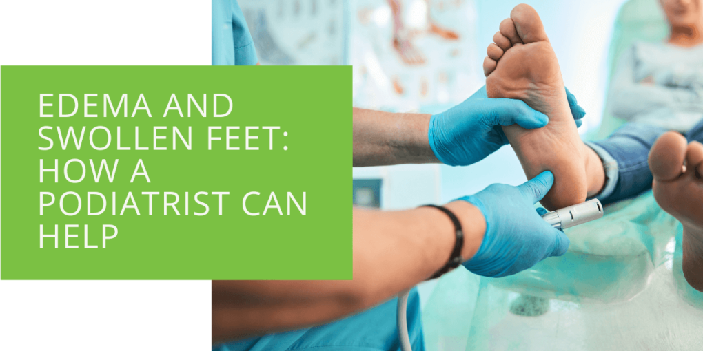 Edema and Swollen Feet How a Podiatrist Can Help