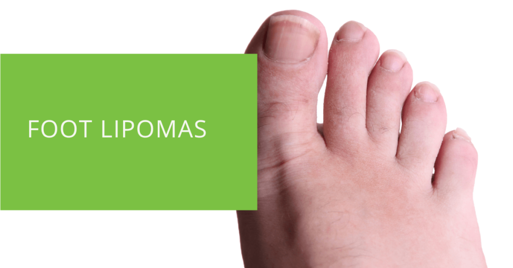 Foot Lipomas