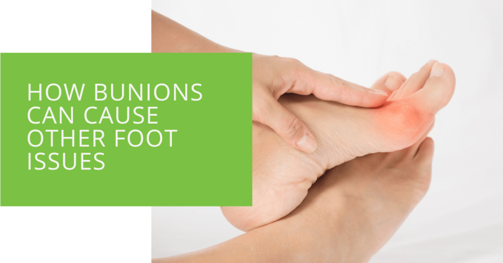 How Bunions Can Cause Other Foot Issues