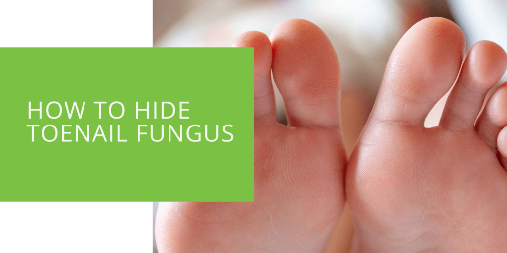 How to Hide Toenail Fungus