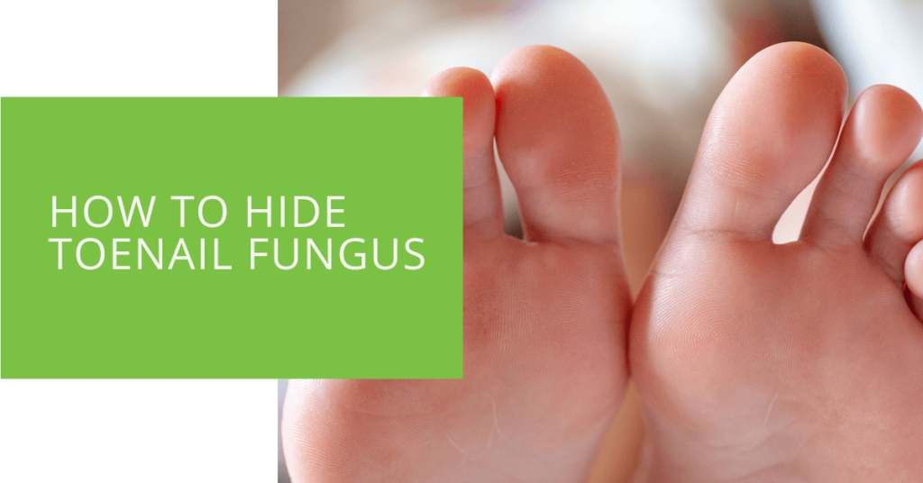 How to Hide Toenail Fungus