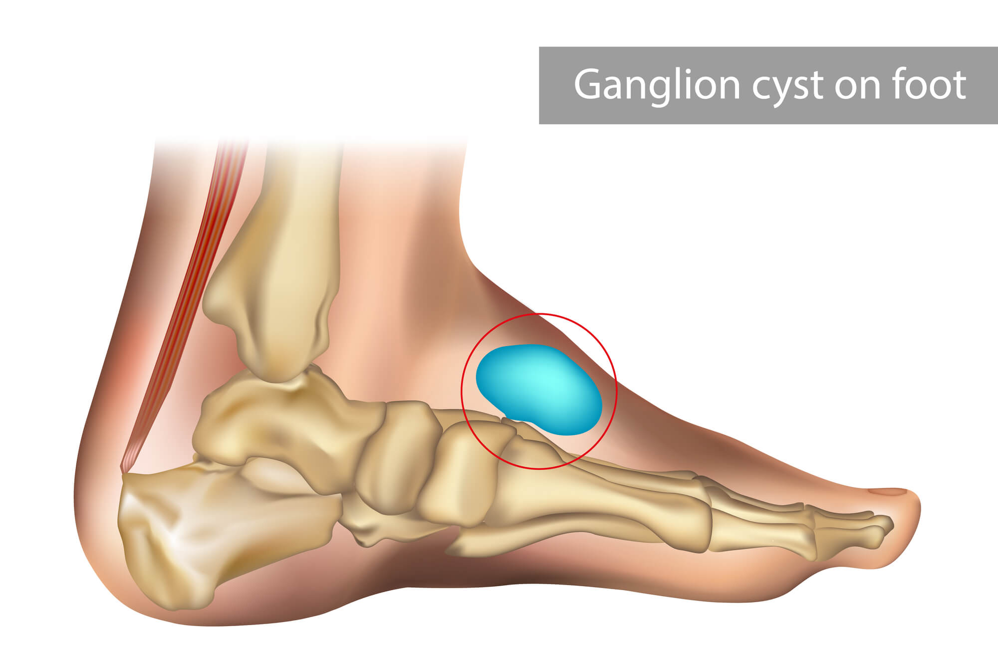 Illustration of a ganglion cyst on the foot