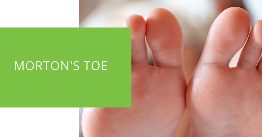 Morton's Toe