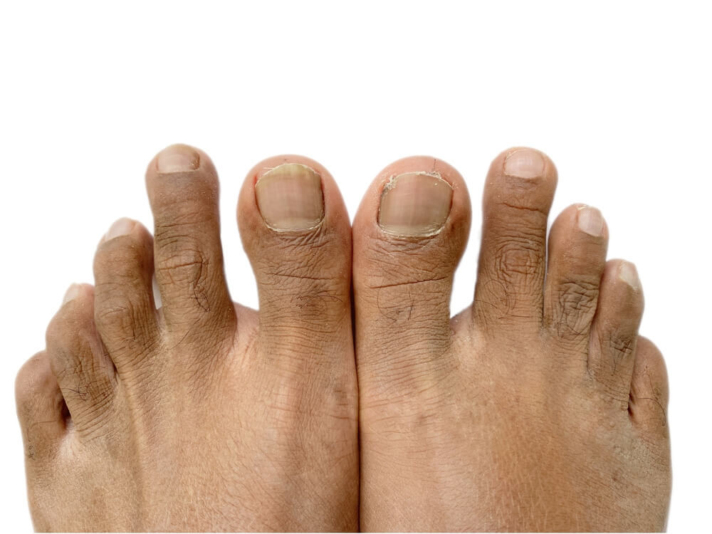 Morton's Toe