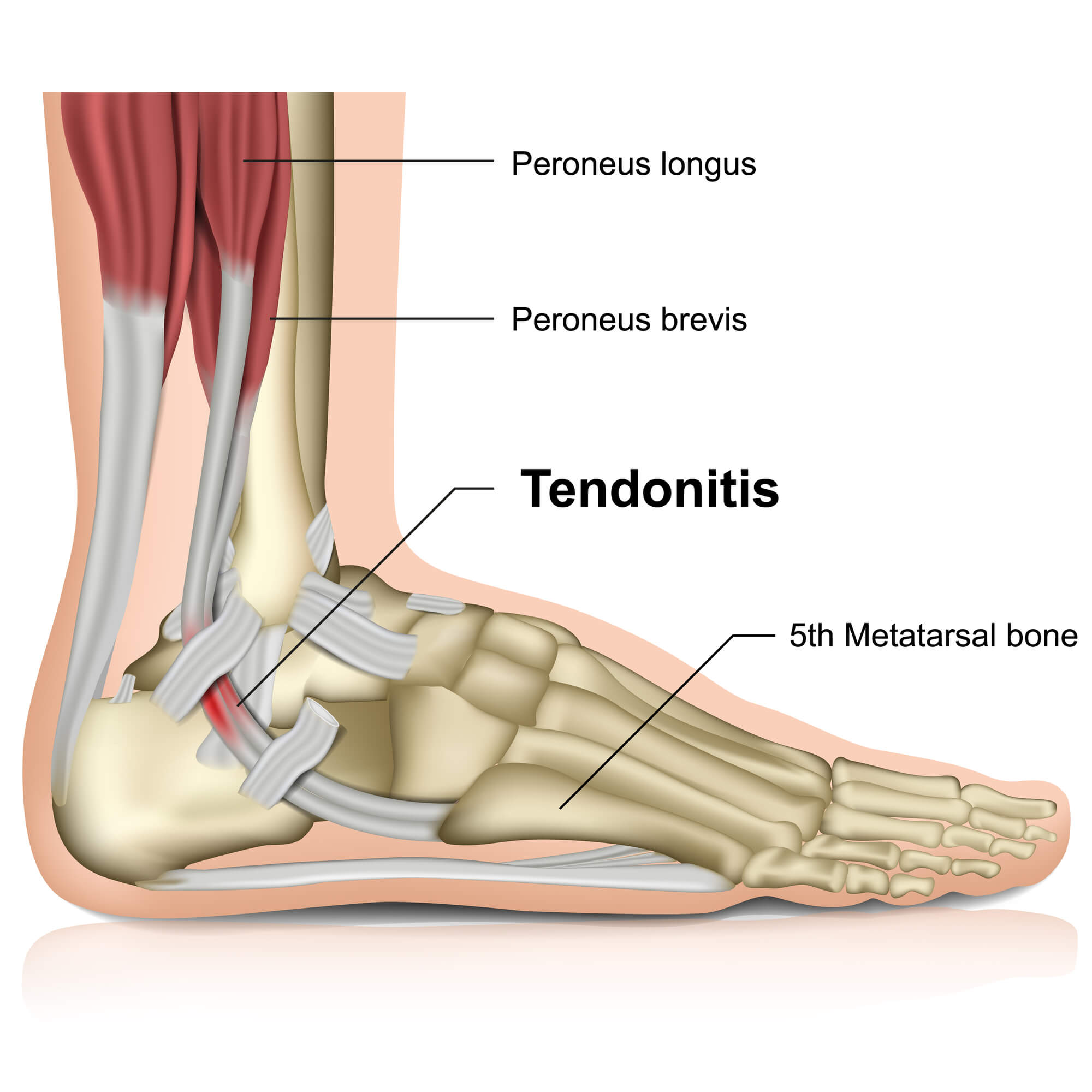 Peroneal Tendonitis