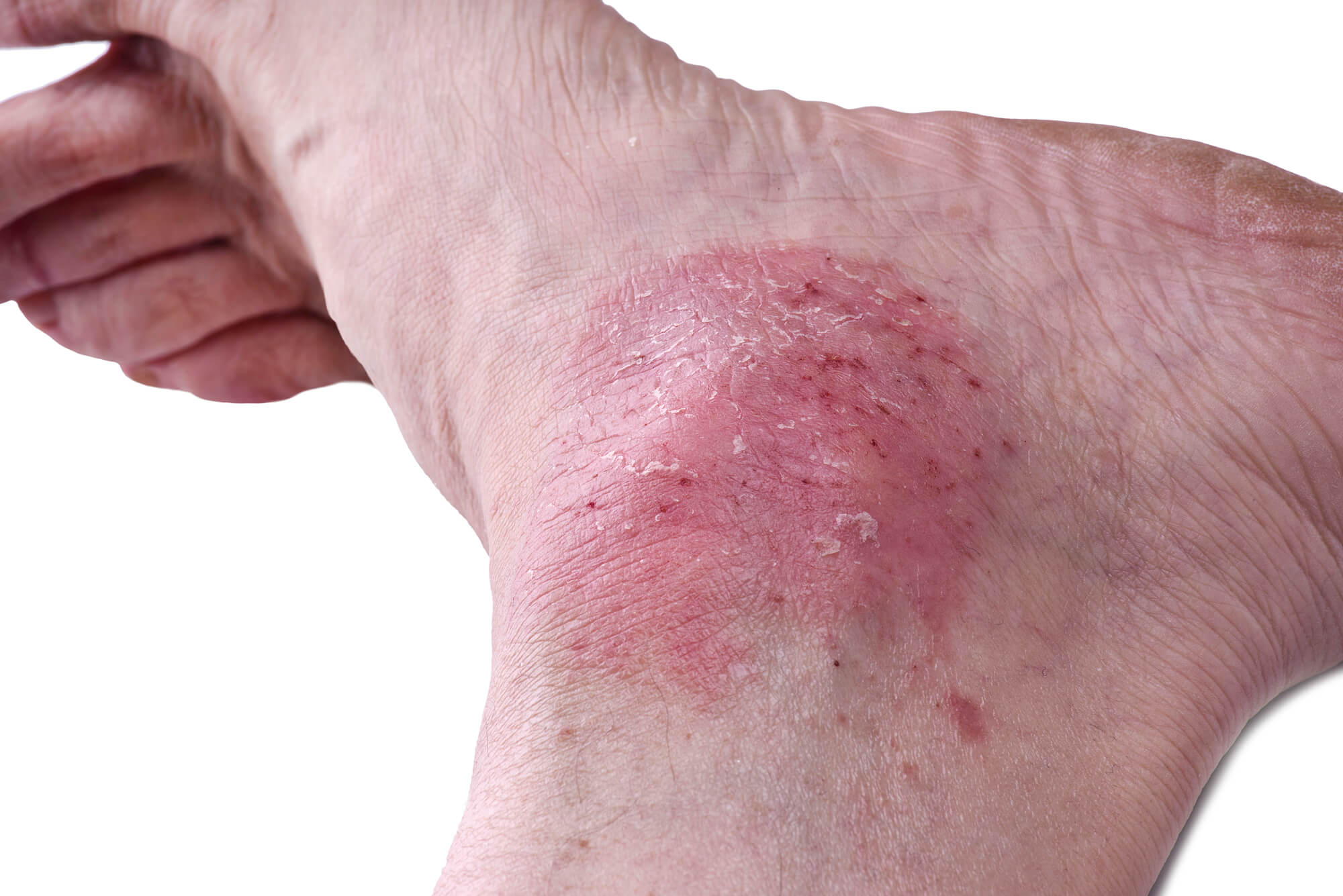 Psoriasis on foot