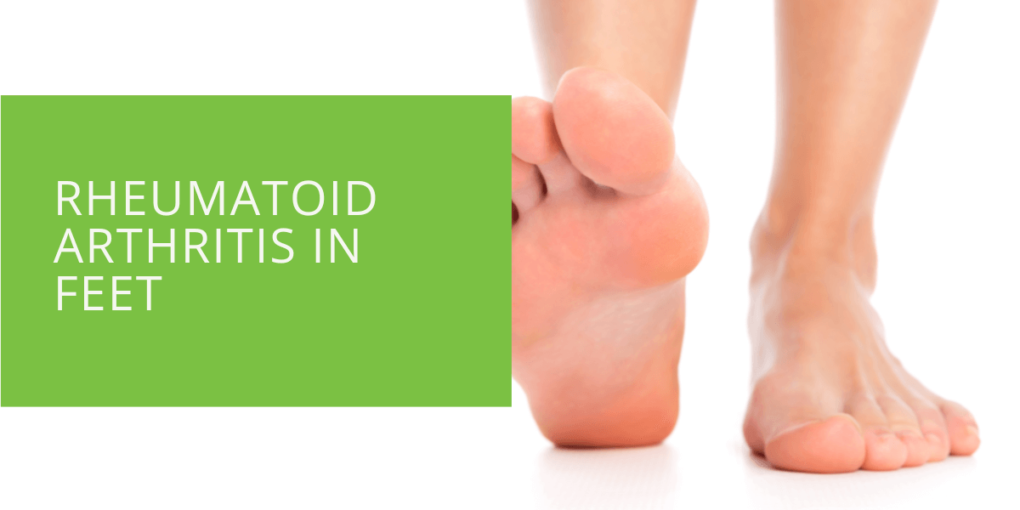 Rheumatoid Arthritis in Feet