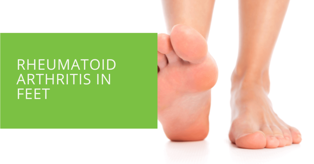 Rheumatoid Arthritis in Feet