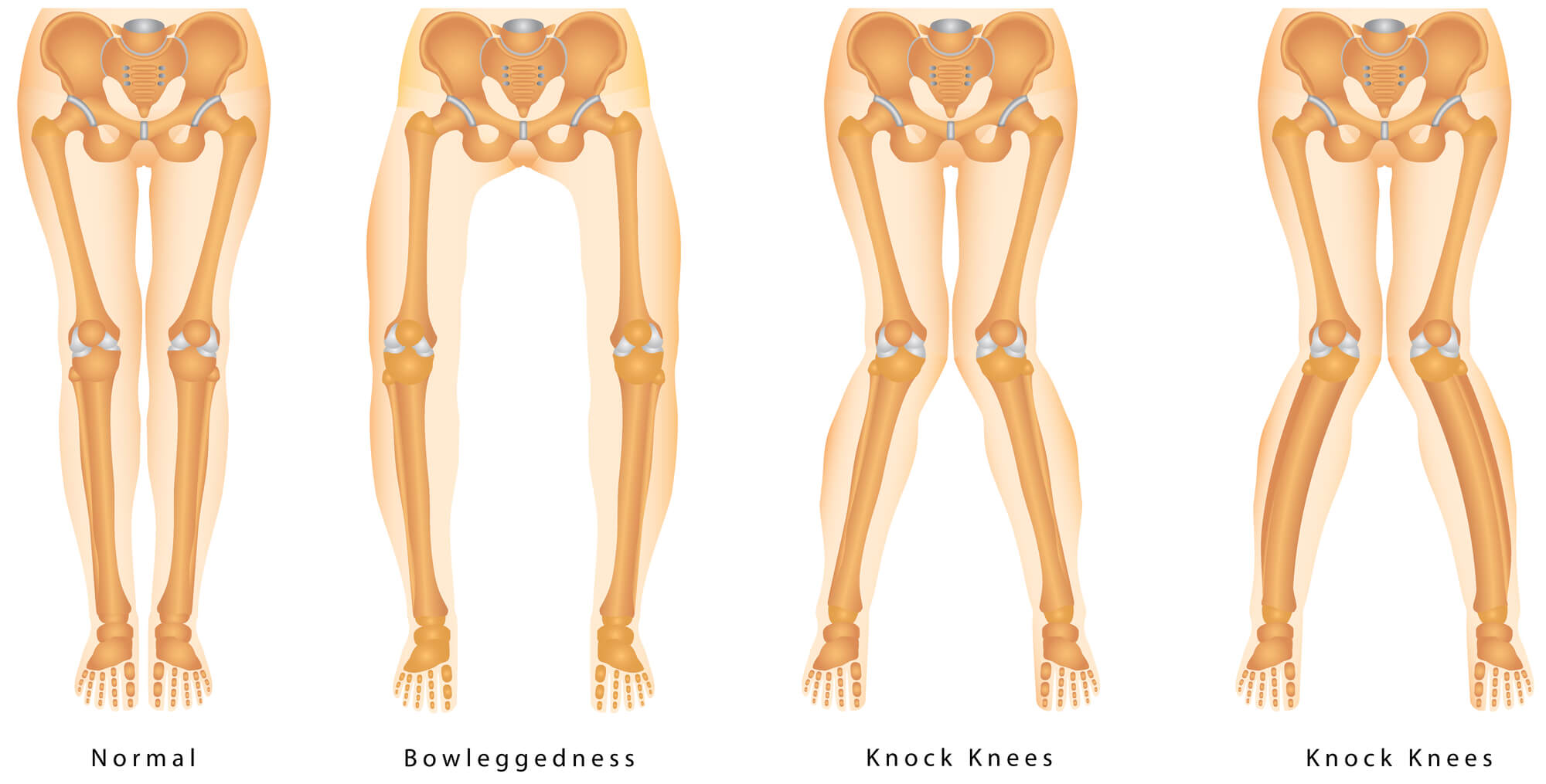 Shapes of the legs