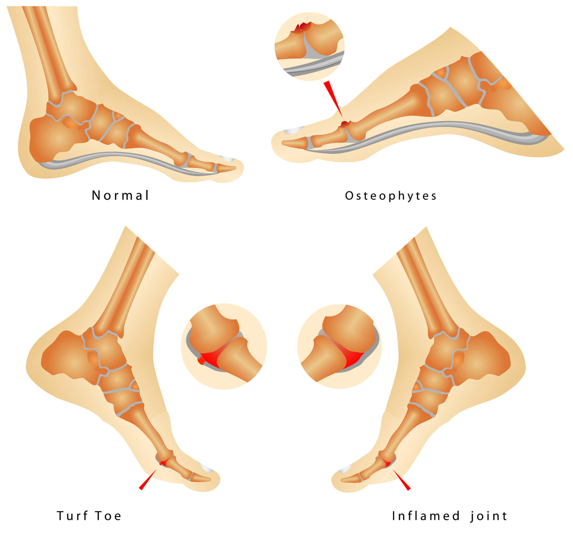 Turf Toe