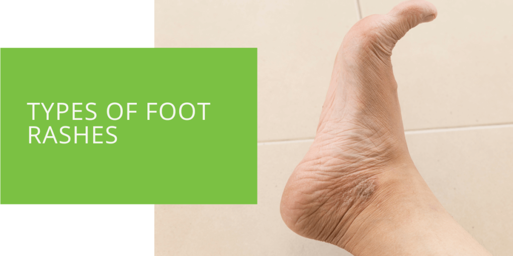 Types of Foot Rashes