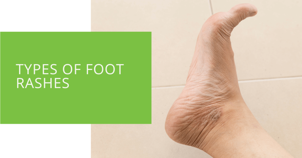 Types of Foot Rashes