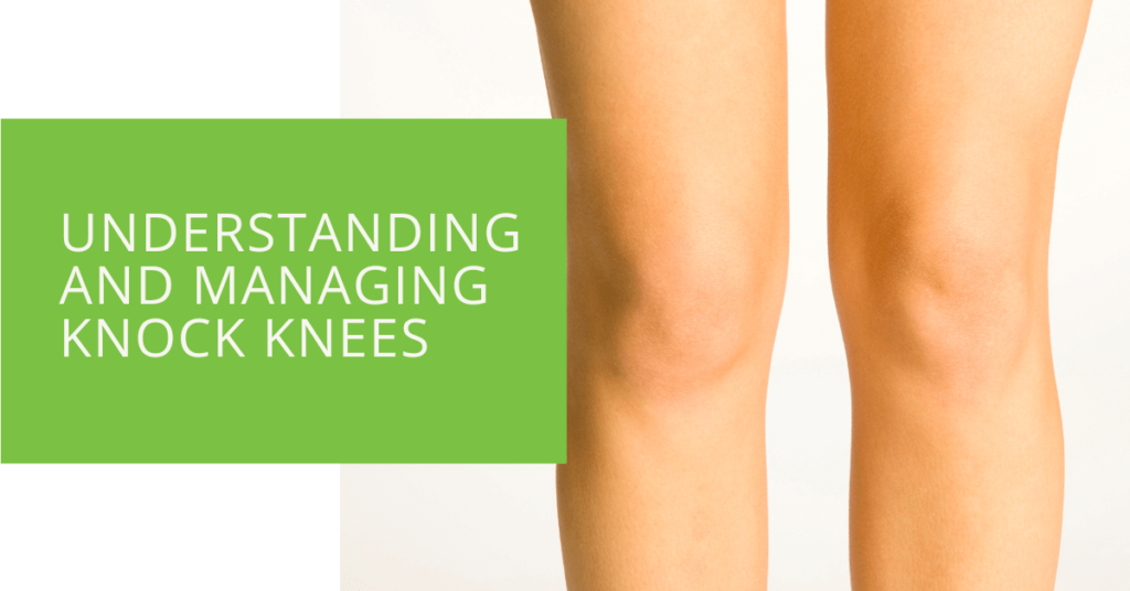 Understanding and Managing Knock Knees