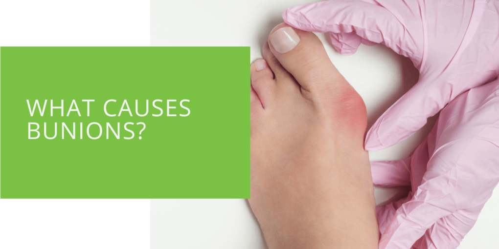 What Causes Bunions