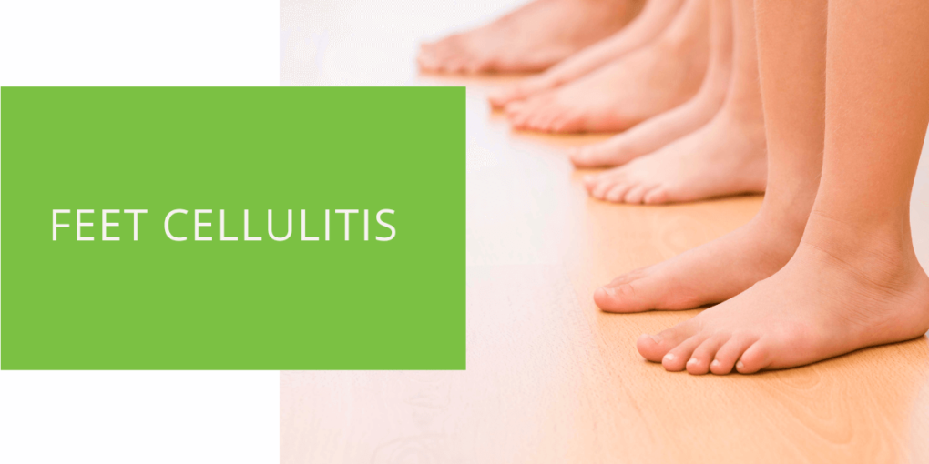 Feet Cellulitis