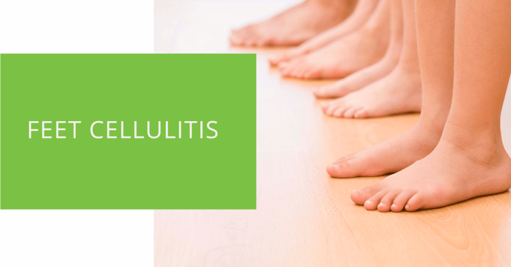 Feet Cellulitis