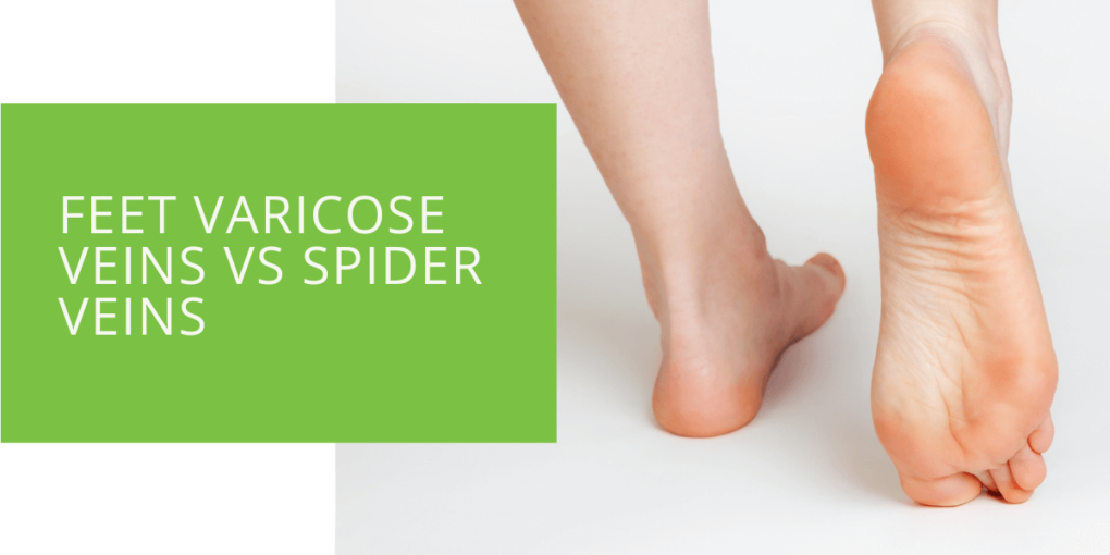 Feet Varicose Veins vs Spider Veins