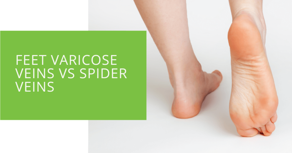Feet Varicose Veins vs Spider Veins