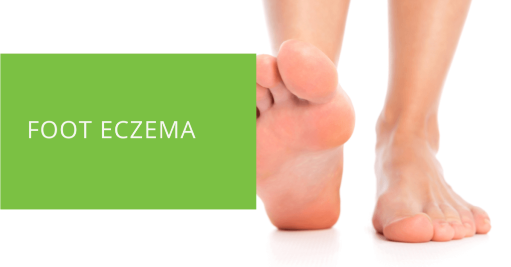 Foot Eczema