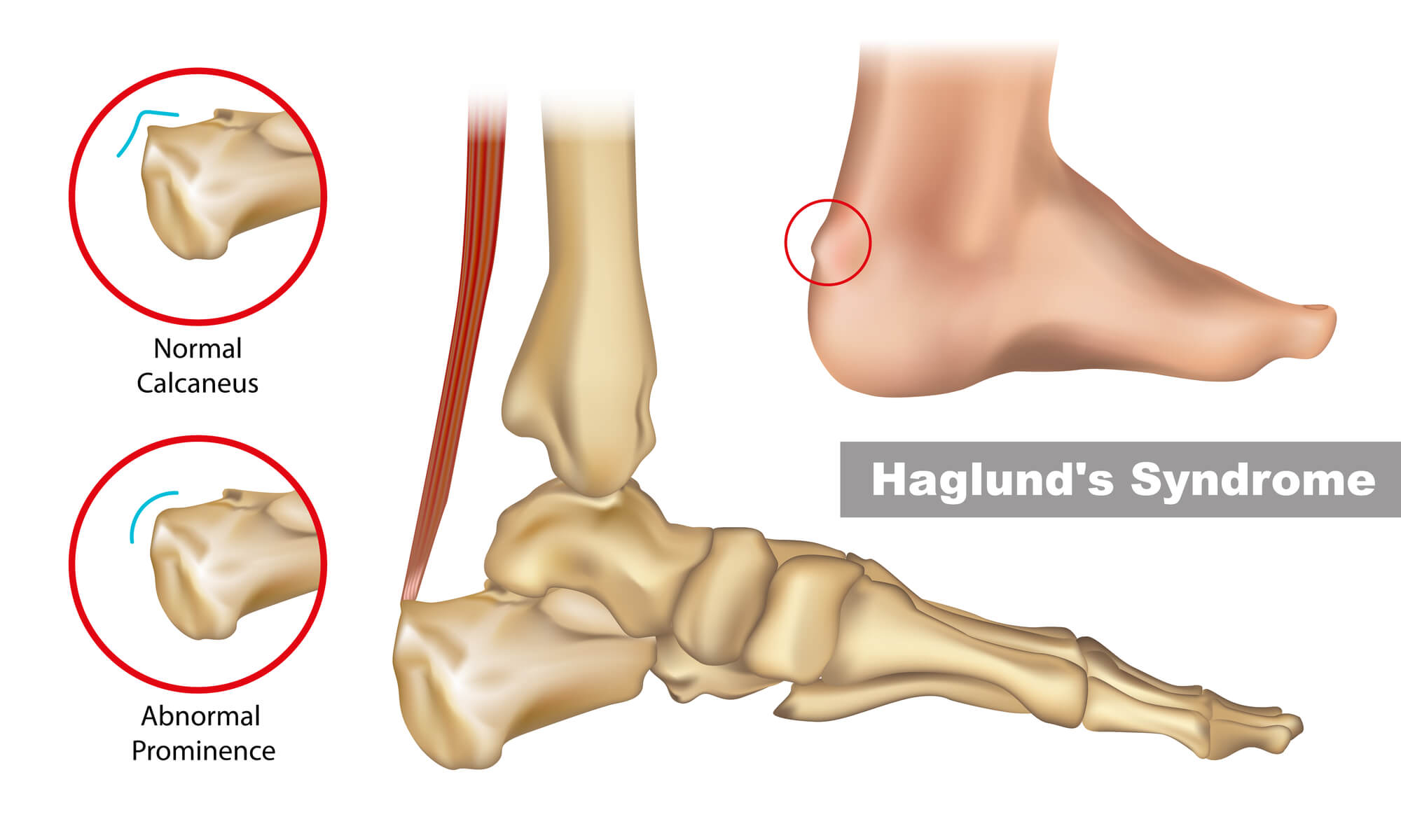 Haglund's Deformity