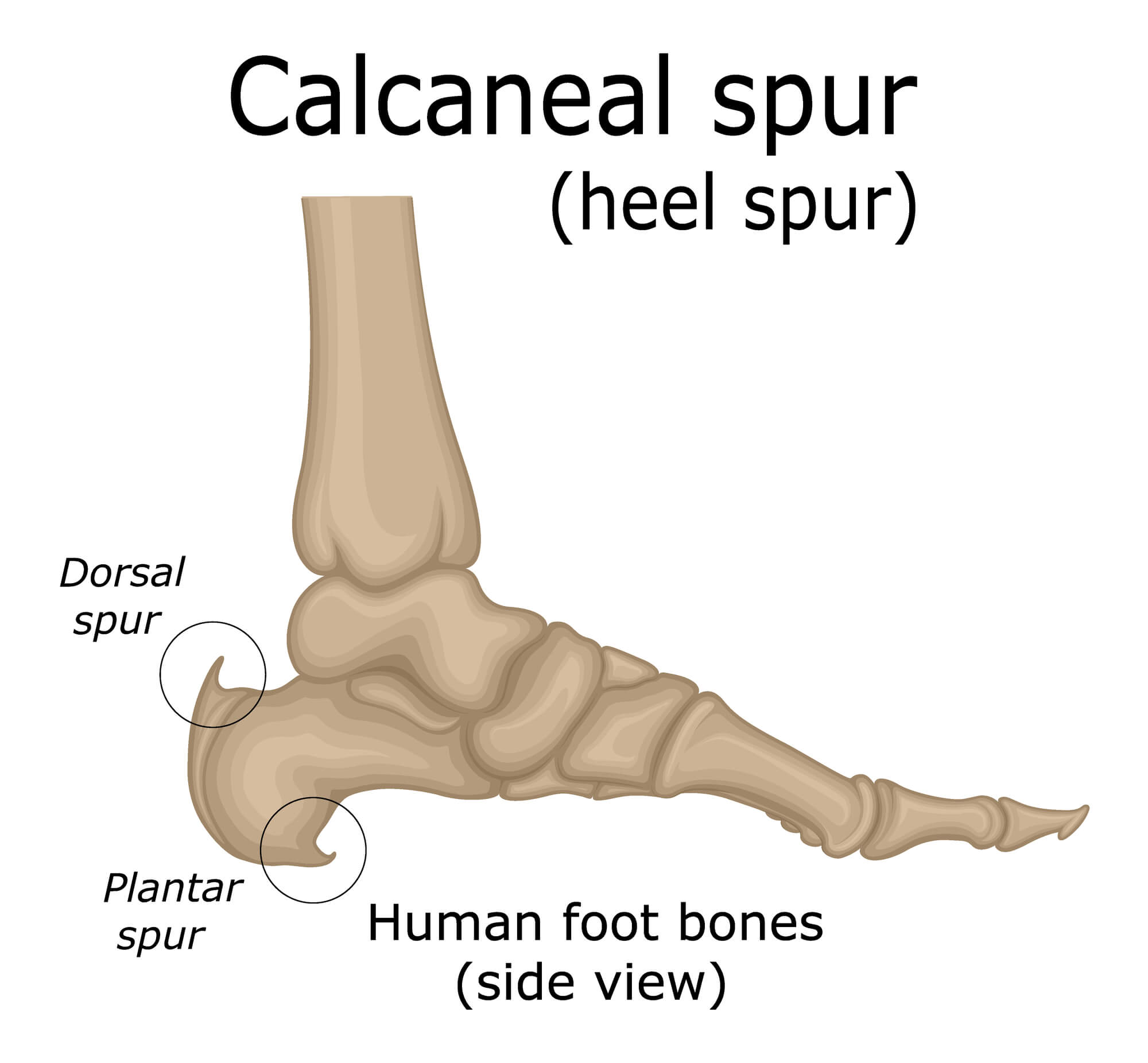 Treatment of Heel Spur Through Physiotherapy - By Dr. Vishwas Virmani |  Lybrate