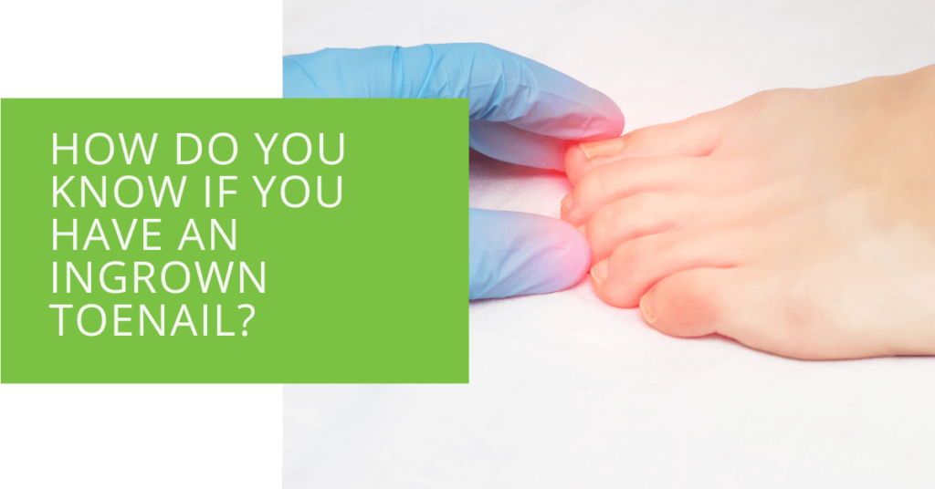 How Do You Know If You Have an Ingrown Toenail