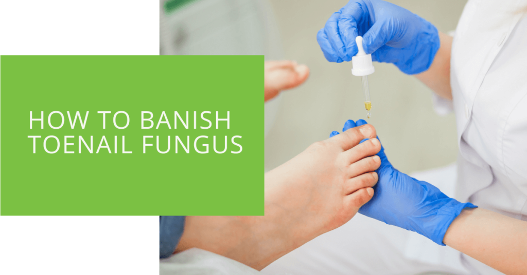 How to Banish Toenail Fungus