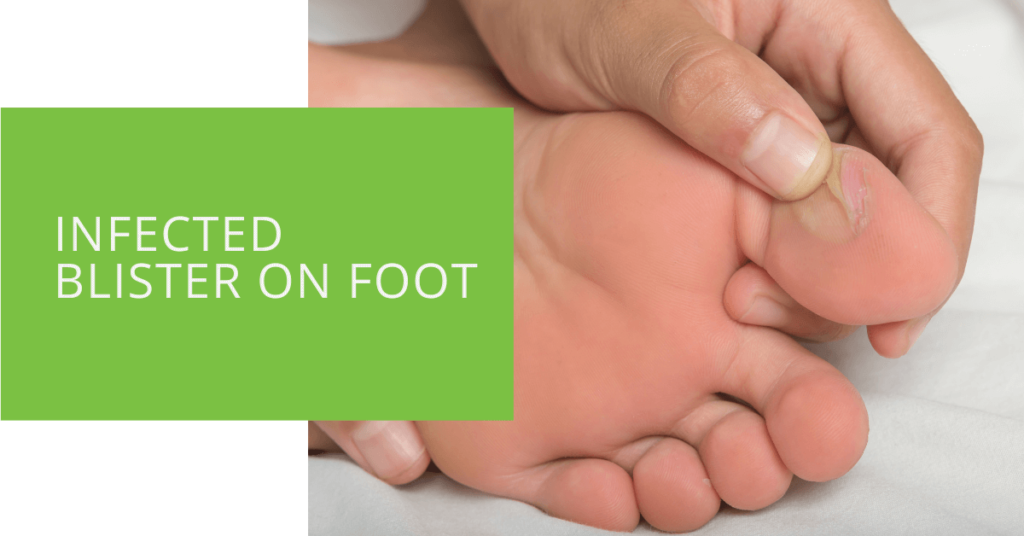 Infected Blister on Foot