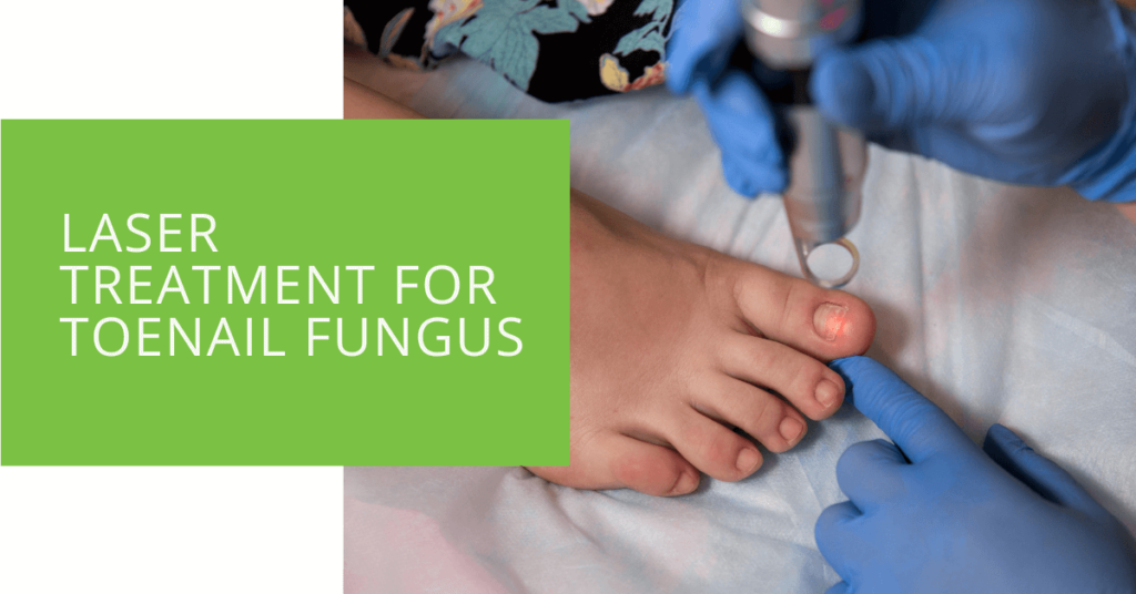Laser Treatment for Toenail Fungus