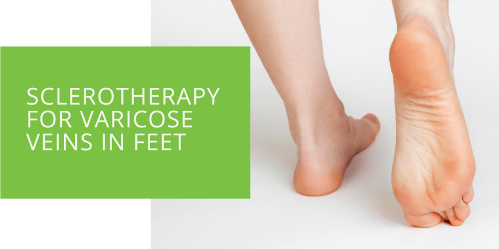 Sclerotherapy for Varicose Veins in Feet