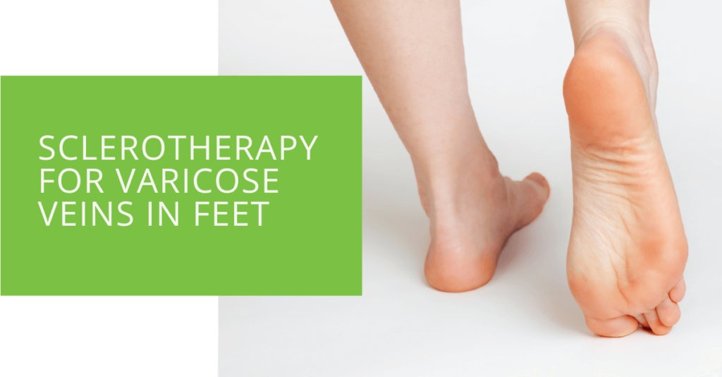 Sclerotherapy for Varicose Veins in Feet