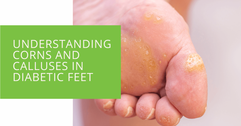 Understanding Corns and Calluses in Diabetic Feet