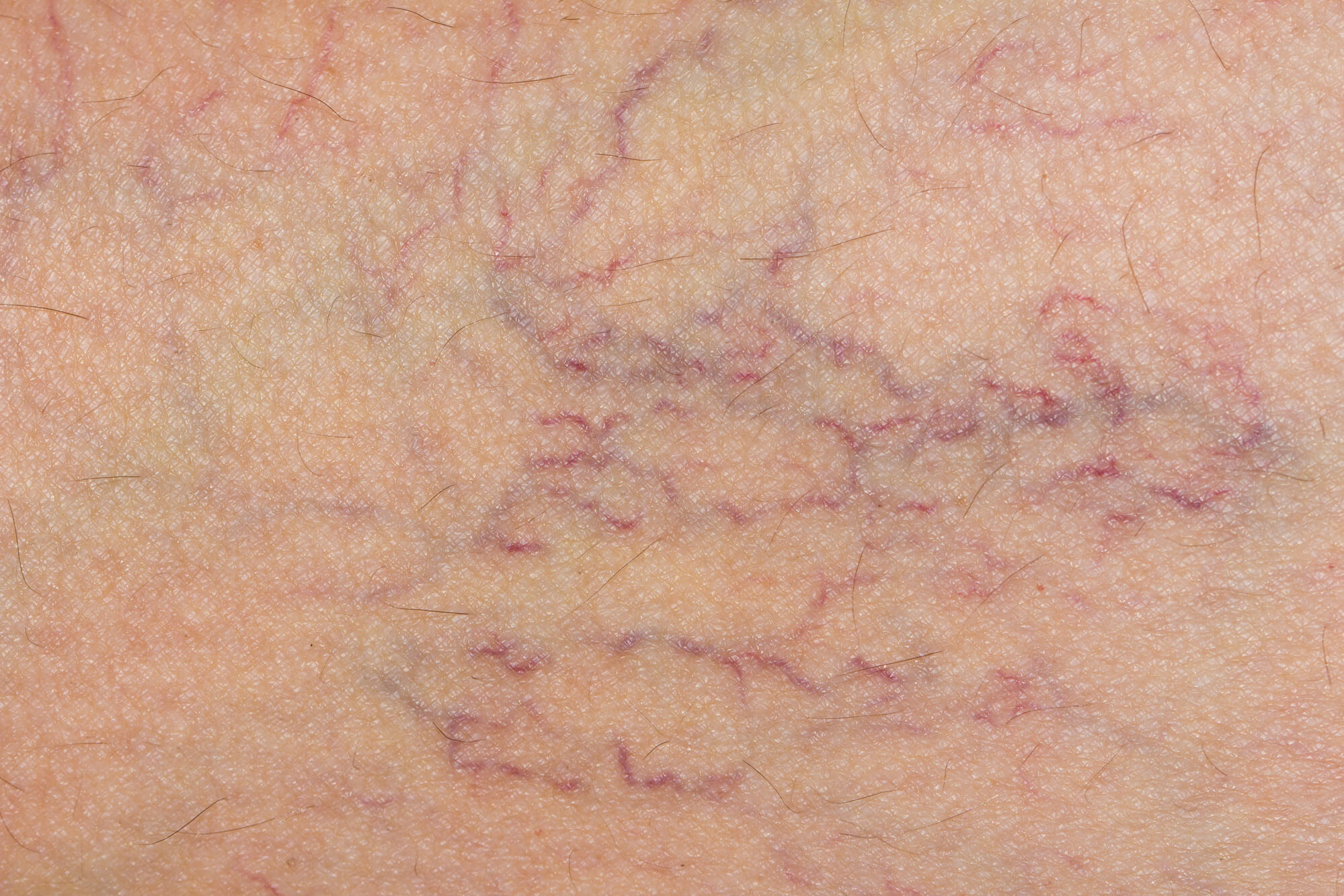 Varicose Veins