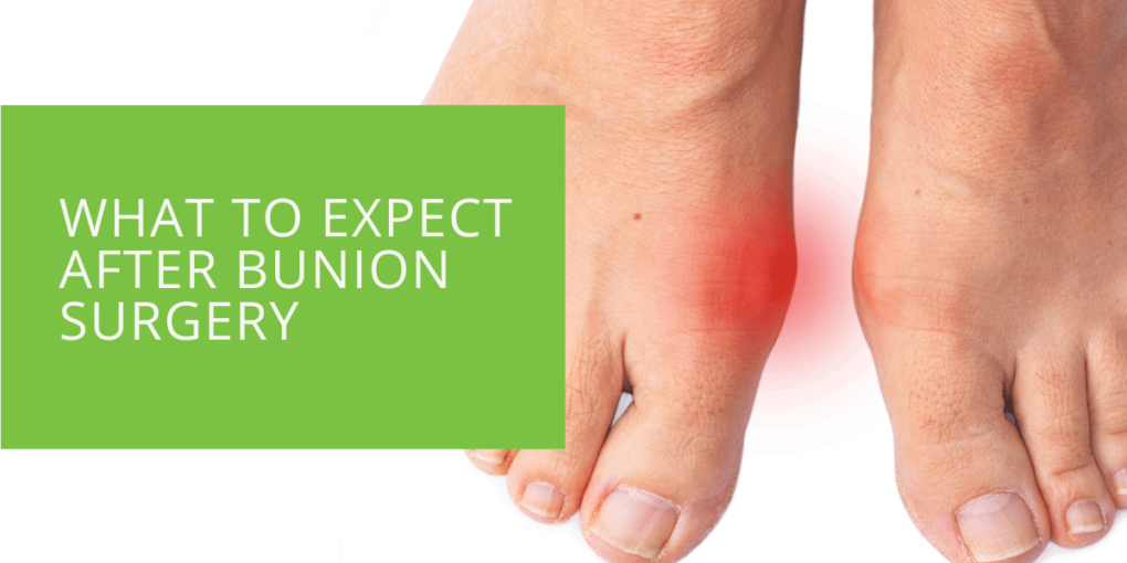 What to Expect After Bunion Surgery