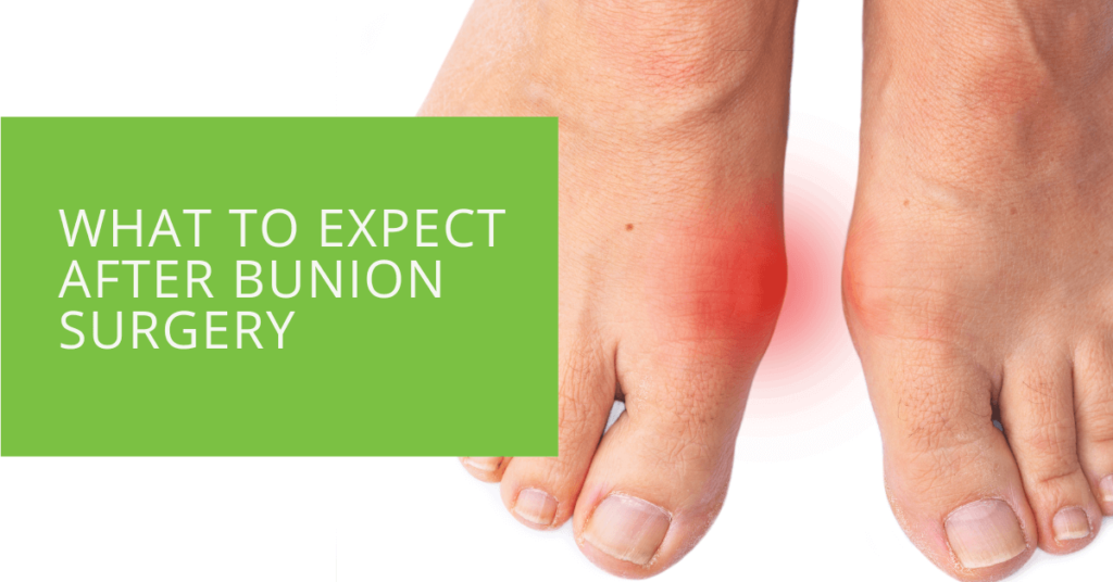 What to Expect After Bunion Surgery