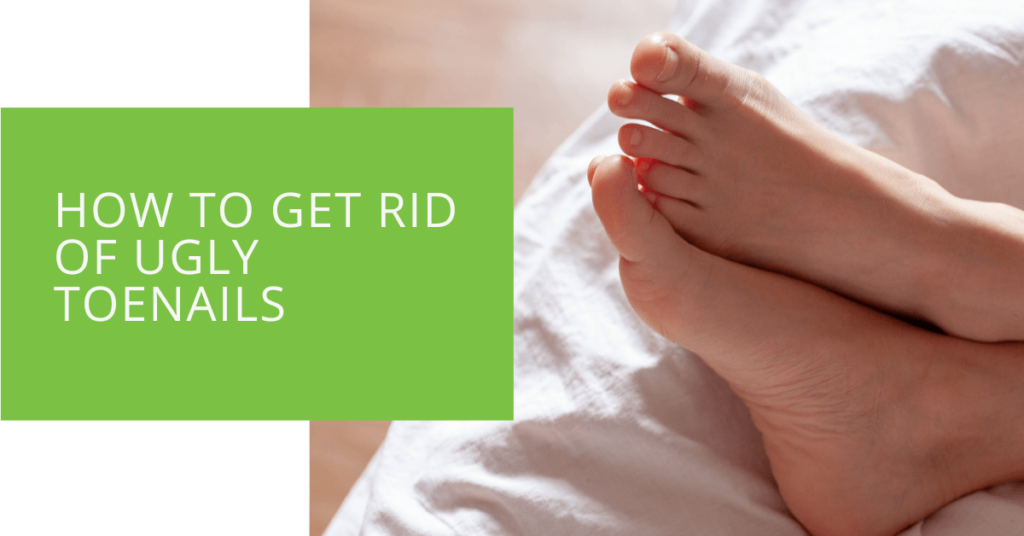 How to Get Rid of Ugly Toenails