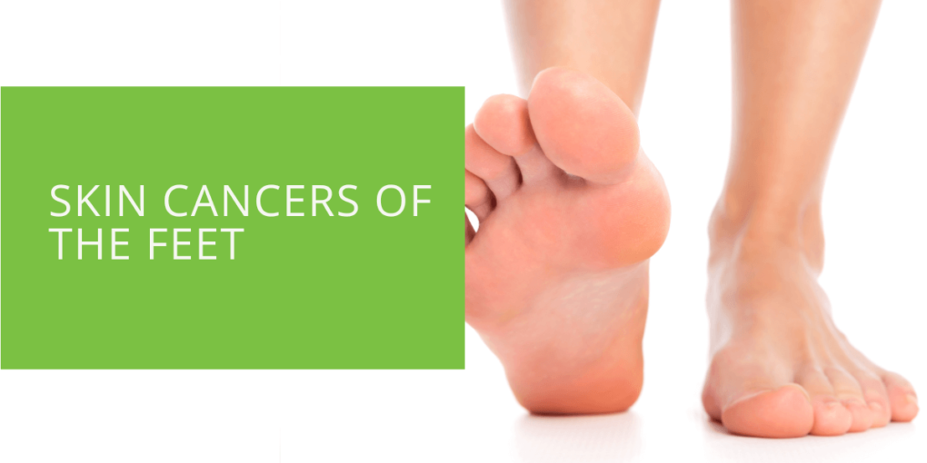 Skin Cancers of the Feet