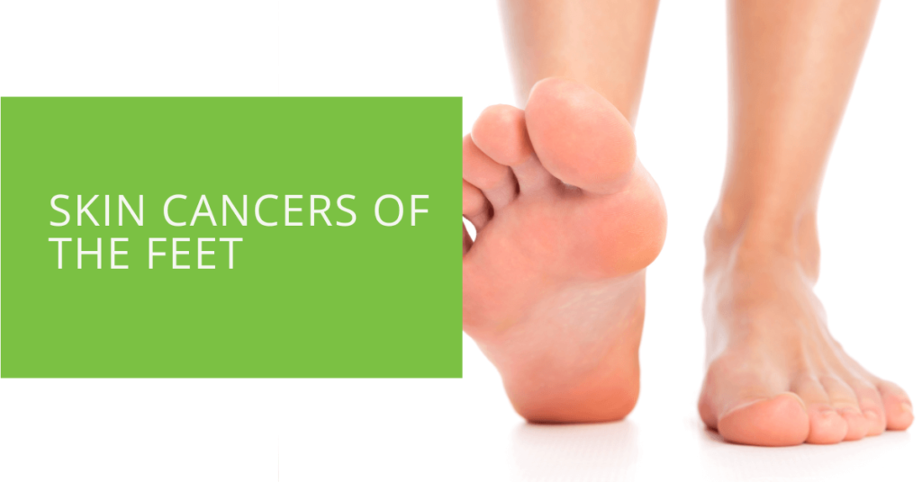 Skin Cancers of the Feet