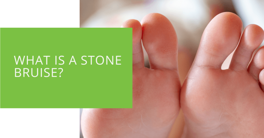 What is a Stone Bruise