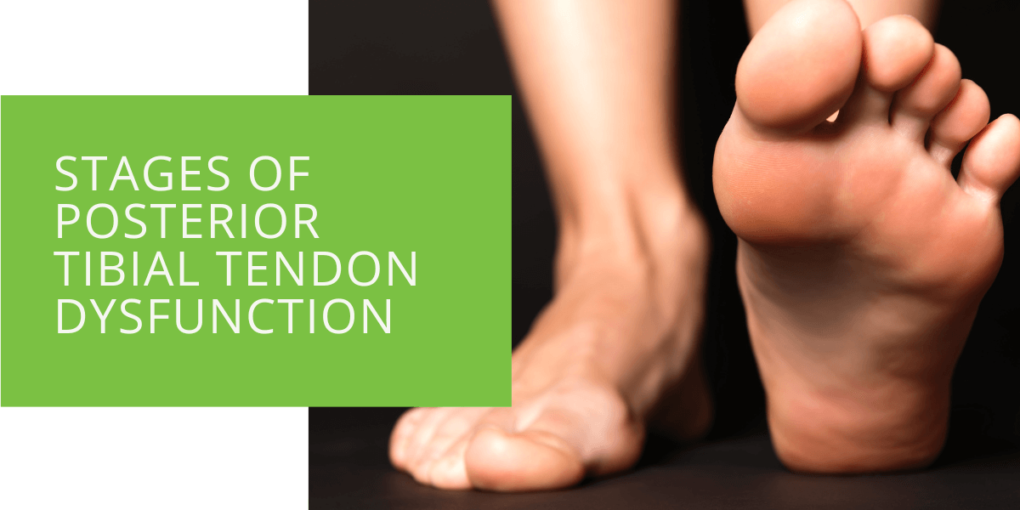 Stages of Posterior Tibial Tendon Dysfunction