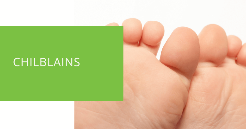 Chilblains